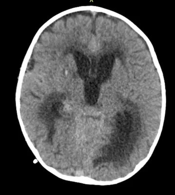 Что такое гидроцефалия, из-за чего рождаются дети с увеличенным черепом и  как лечат гидроцефалию нейрохирурги НИКИ педиатрии?.. | ВКонтакте