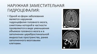 МРТ смешанная заместительная гидроцефалия | Второе мнение