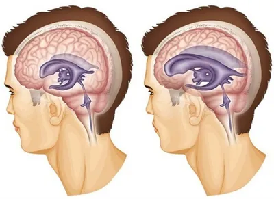 Гидроцефалия, причины симптомы и лечение | МЦ Докторплюс, Сургут