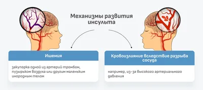 Реабилитация после инсульта в Москве: цены в клинике, врачи, отзывы  пациентов