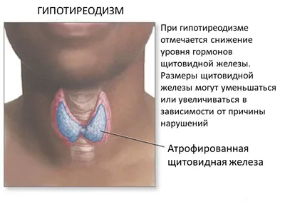 Гипотиреоз и гипертиреоз – две стороны одной монеты - Свиридонова Марина  Александровна, эндокринолог, диетолог, специалист по ожирению