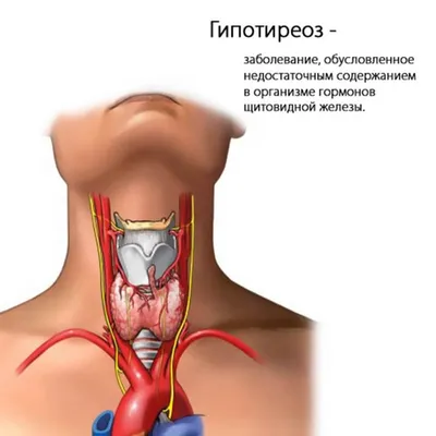 Новость Чем опасен гипотиреоз и как распознать первые симптомы?