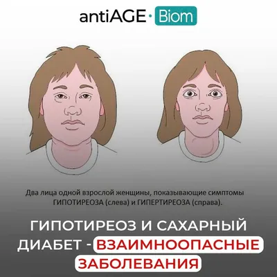 Гипотиреоз🧬 ⠀ 📉Гипотиреоз — синдром,... - Vitros Diagnostics | Facebook