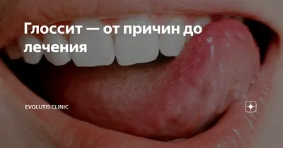 Острый герпетический стоматит - Стоматология Набережные Челны - DENTAL  FORTE \"Дентал Форте\"