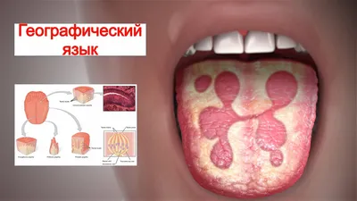 Глоссит: симптомы, лечение, народные средства | Глоссит у детей