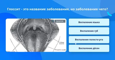 Стоматология брекетов «Ауырма Жаным» - Складчатый глоссит (также именуемый  скротальным) является врожденной или приобретенной патологией языка,  возникающей вследствие увеличенных мышц этого органа. Язык покрывается  неравномерными бороздками. Увеличение ...