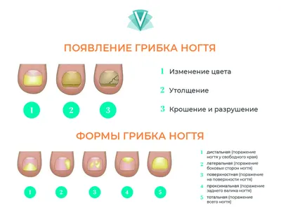 Грибок на пальцах рядом вверх Стоковое Фото - изображение насчитывающей  кожа, нога: 180491172