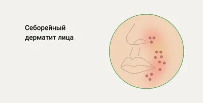 Грибы на коже? Разбираемся с грибами Malassezia (Pityrosporum) |  Skinhacking - больше, чем просто о коже | Дзен