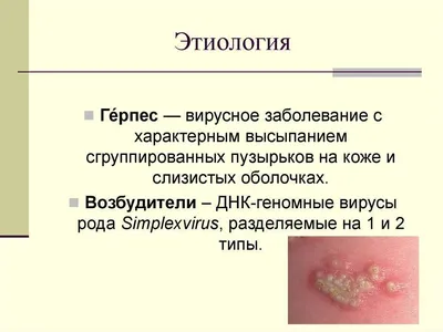 Виды герпеса на лице: в носу, на губах, подбородке и на глазу – симптомы и  как лечить герпес