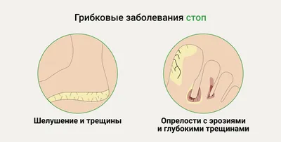 Лечение грибка кожи в Москве в отделении дерматовенерологии клиники ИАКИ