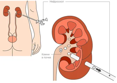 Камни в почках - симптомы и лечение - блог Медюнион