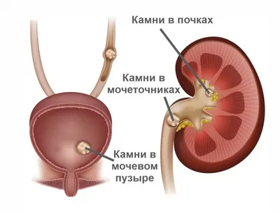 КАМНИ (КОНКРЕМЕНТЫ) ПРИ МОЧЕКАМЕННОЙ БОЛЕЗНИ