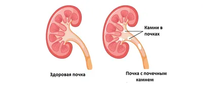 Камни в почках. ТОП 5 продуктов, провоцирующих мочекаменную болезнь