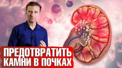 Камни почки после литотрипсии | Пикабу