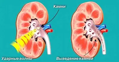 Камни в почках: как появляются, можно ли растворить и как проходит лечение?  - Медицинский центр \"Допомога+\"