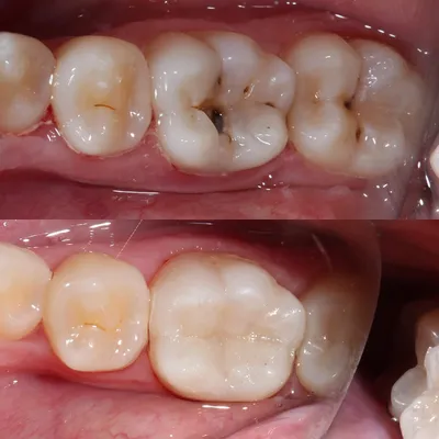 Пришеечный кариес. Диагностика, лечение, профилактика, стадии...