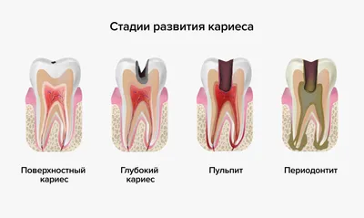 Глубокий кариес: симптомы и методы лечения зубов препаратами