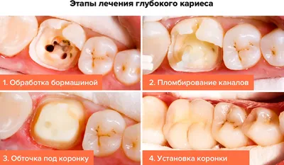 Кариес|Стоматологический центр Иркутск