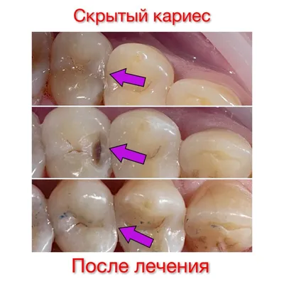 Лечение кариеса в Нижнем Новгороде, цена | Стоматология Диагональ