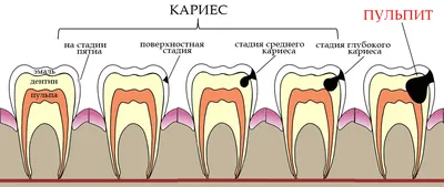 Скрытый кариес: симптомы, причины, лечение, профилактика, фото скрытого  кариеса, цены в Москве