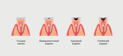 Глубокий кариес - стоимость услуги Кариес у взрослых в Киеве, Глубокий  кариес - цена в стоматологии lipinskii.com.ua