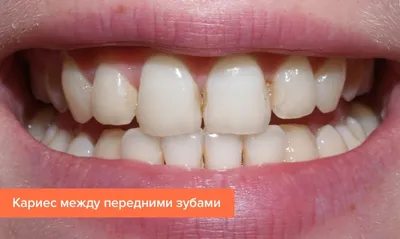 Кариес дентина 26, 27 зубов, до и после лечения - MagicDent