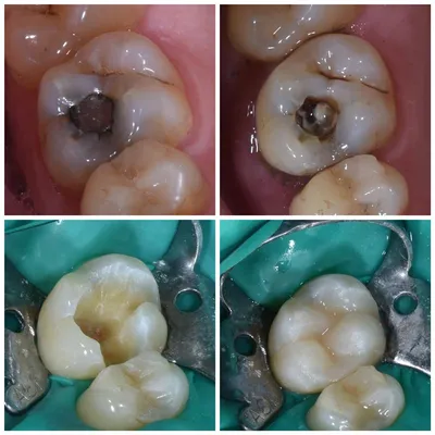 Лечение кариеса зубов, любая сложность кариеса