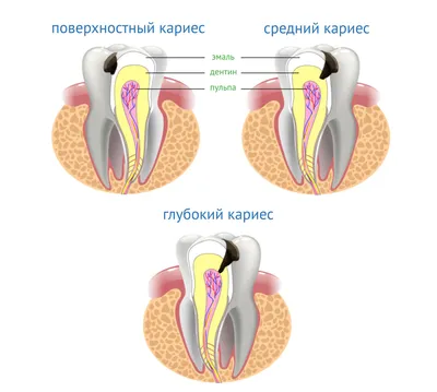 Кариес под пломбой | Работы врача-стоматолога Грыцив Э. И. | Наши работы