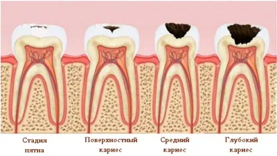 Лечение кариеса в Челябинске | Дента