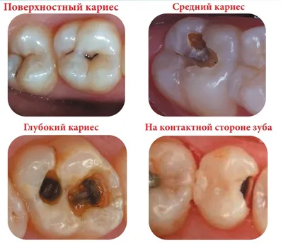 Апроксимальный кариес — сложности в выявлении и профилактике — Эстетическая  стоматология Deva-Dent в Москве