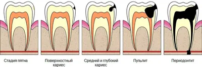 ВОВРЕМЯ ВЫЯВЛЕННЫЙ СКРЫТЫЙ КАРИЕС - Стоматологическая клиника Лазурит