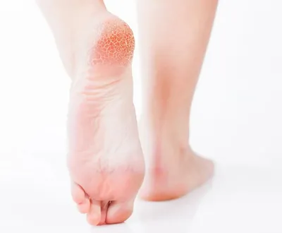 Массаж стоп ног в домашних условиях– профилактика заболеваний  опорно-двигательного аппарата