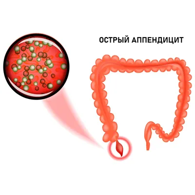 Острый аппендицит - диагностика и лечение в Москве. Консультация врача.