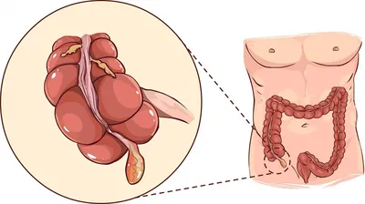 Səhhət Klinikası /Sahhat German-Azerbaijani Medical Center - 🔴Основные  признаки аппендицита у взрослых включают: ✓ Острую боль в животе, в том  числе и при надавливании ✓ Повышение температуры ✓ Тошноту ✓Рвоту 🔺Первые  симптомы