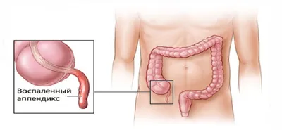 Удаление аппендицита методом лапароскопии | Цены и преимущества