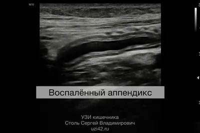 Аппендицит и причина появления. | Пороки, болезни, карма. | Дзен