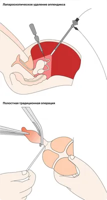 Аппендицит на УЗИ? - УЗИ в Новокузнецке