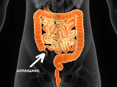 Как мне аппендицит без показаний оперировали. | Пикабу