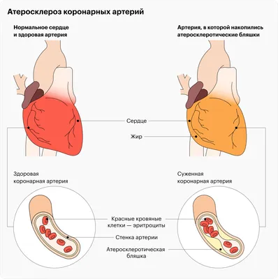 боль в сердце человек захватывает область сердца рукой, страдая от боли в  груди, сердечный приступ или боль Стоковое Изображение - изображение  насчитывающей рука, ацетона: 216800609