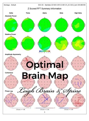 Brain Maps May Reveal the Origins and Paths of Neurological Dysfunction