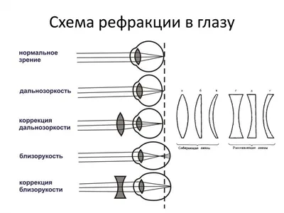 Расфокусировка зрения: симптомы, лечение, профилактика и как с ней бороться