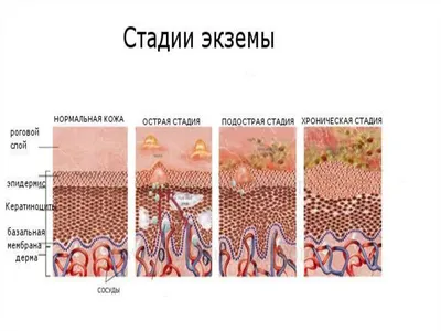 Экзема - лечение в Ростове-на-Дону