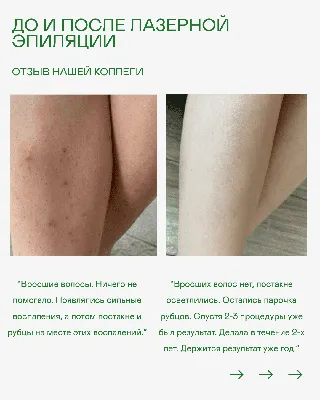 Лазерная эпиляция в Калининграде - Эффективно и безопасно. Клиника  «Лазерная медицина»