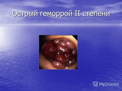 Геморрой — симптомы и лечение геморроя