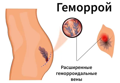 Геморрой у женщин: причины, симптомы, признаки, что делать, как избавиться,  лечение