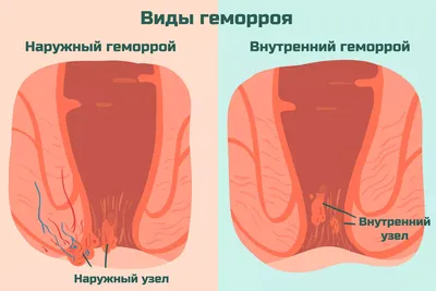 Лечение геморроя без операции методом катетеризации - ENDORAD