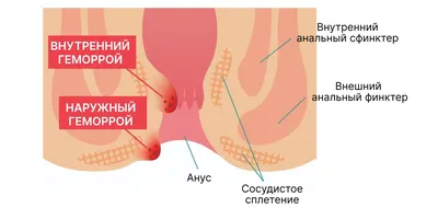 Геморрой у женщин - симптомы и лечение - диагностика геморроя