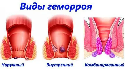 Геморрой: что такое? Как бороться? - статьи от компании Еламед