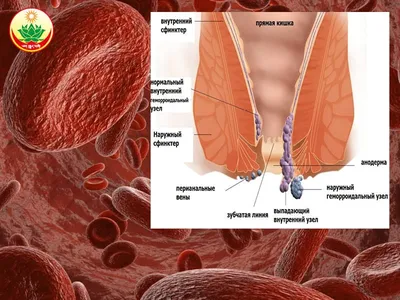 Лечение Геморроя