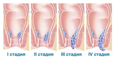 Лечение внутреннего геморроя — симптомы, причины и методы лечения болезни